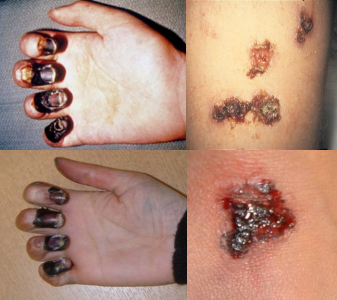 चित्र:Plague symptoms.jpg