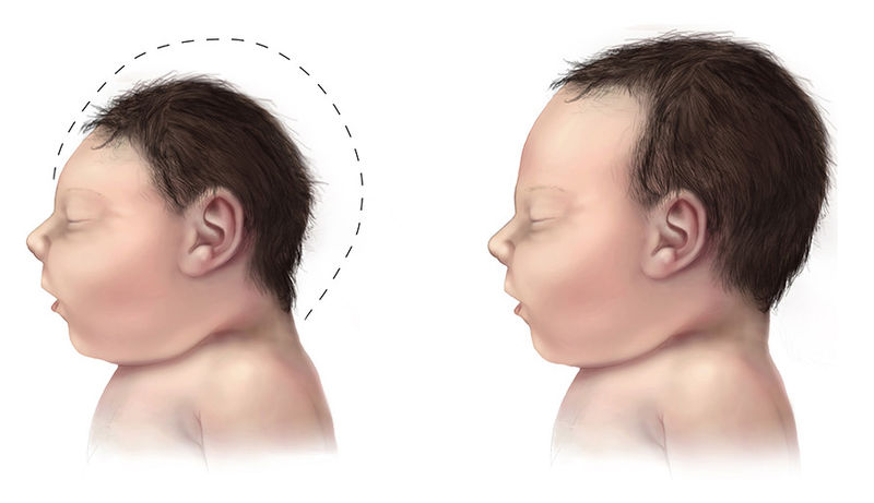 चित्र:Zika-Virus-Infected-Babies-Chid.jpg